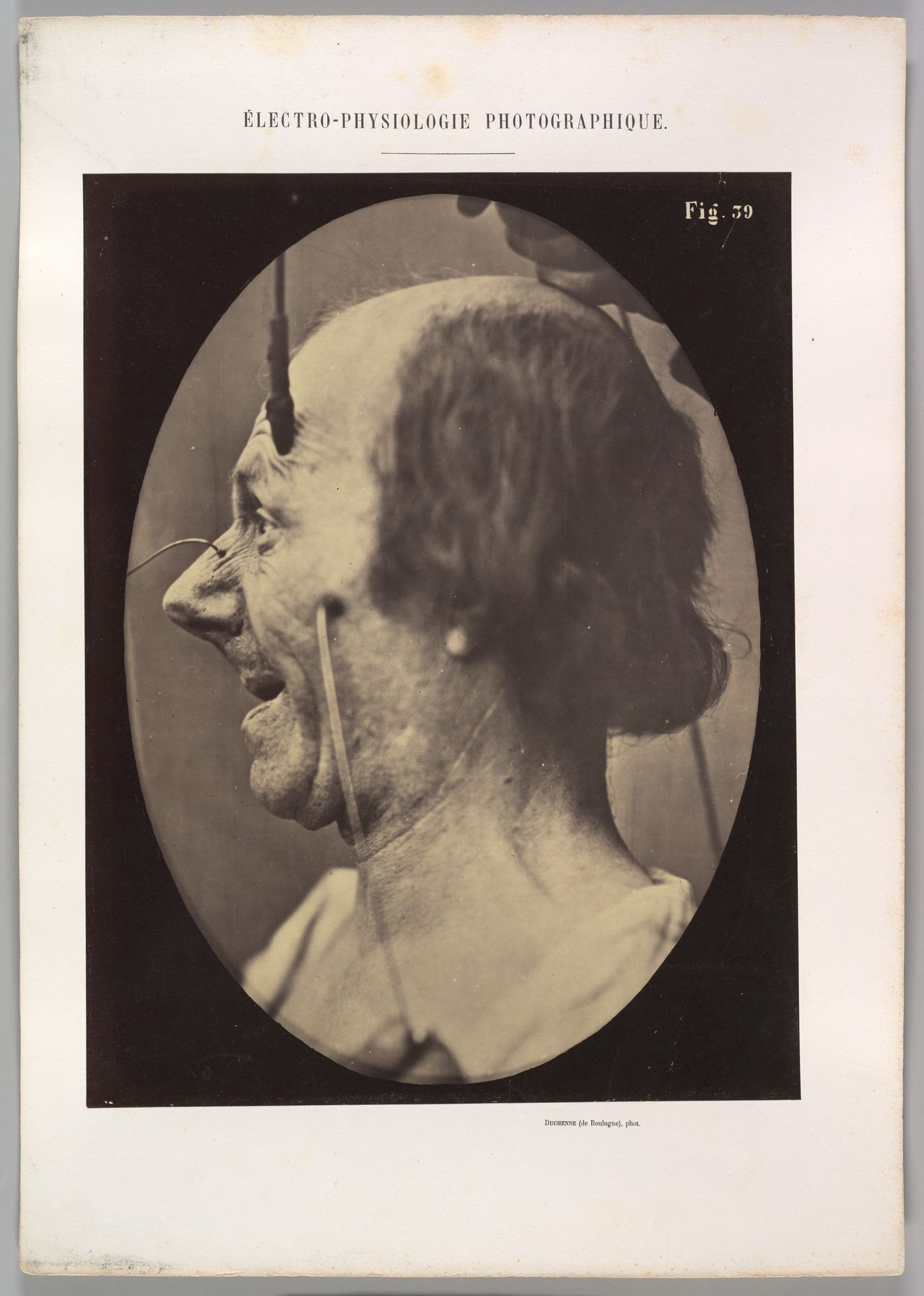 Figure 39: The  attention attracted by an object that provokes lascivious ideas and desires. by Guillaume Benjamin Amand Duchenne