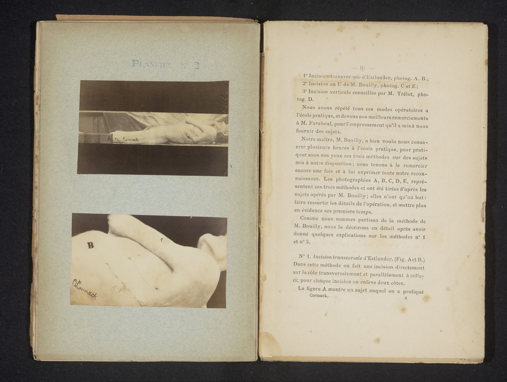 Mannenlichaam met een incisie in de zijkant van het bovenlichaam, volgens de methode van Estlander by Charles Edward Cormack
