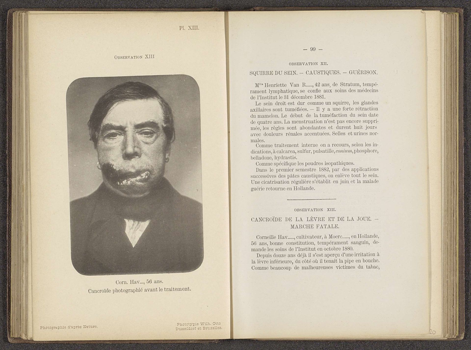 Man met een tumor door huidkanker op de lip by Anonymous