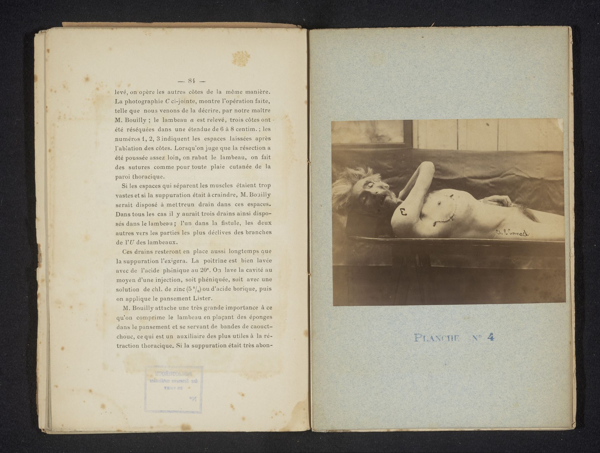 Mannenlichaam met hechtingen onder de borst by Charles Edward Cormack