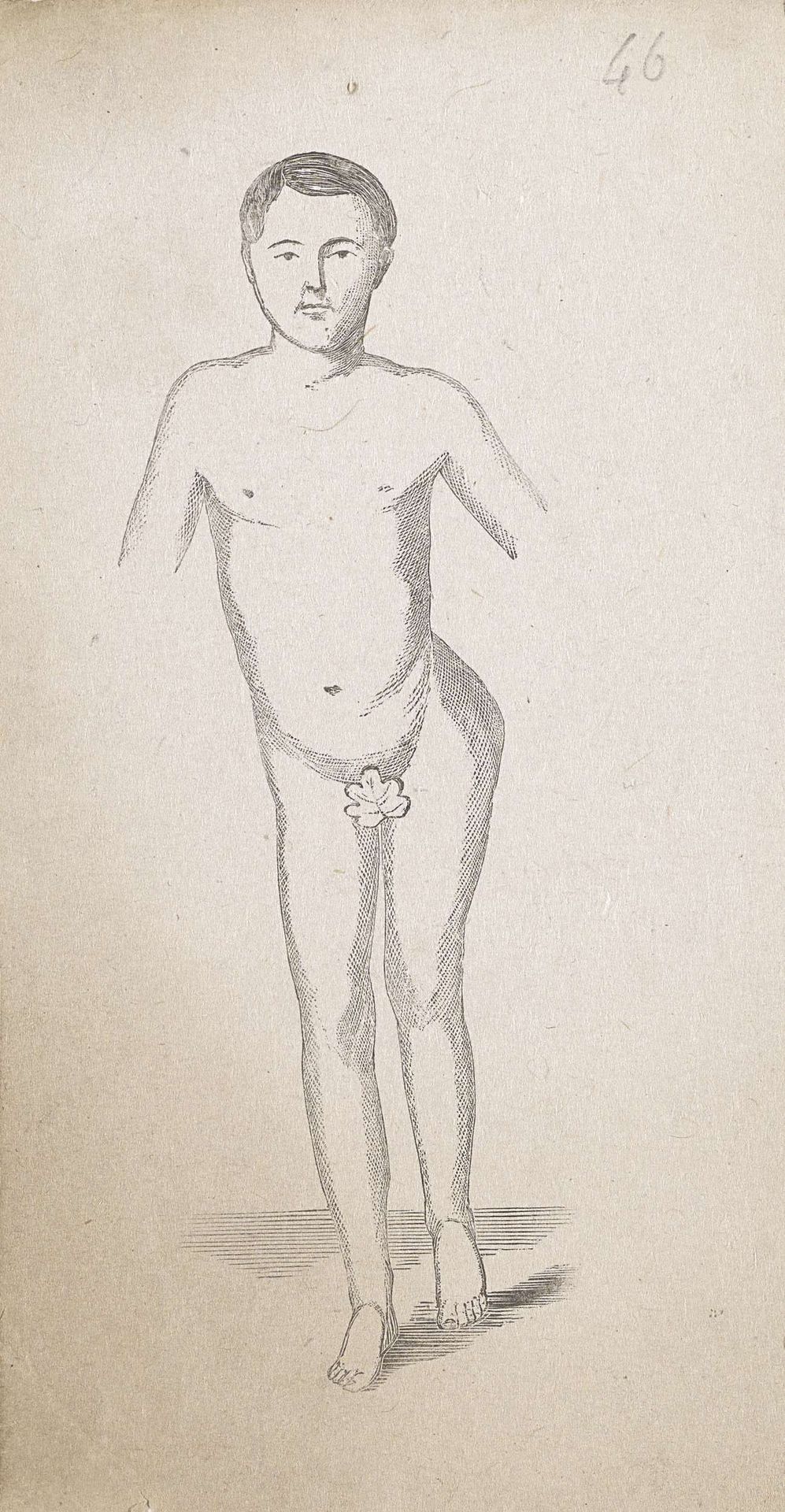 Man met een afwijking in het bekken by Isaac Weissenbruch