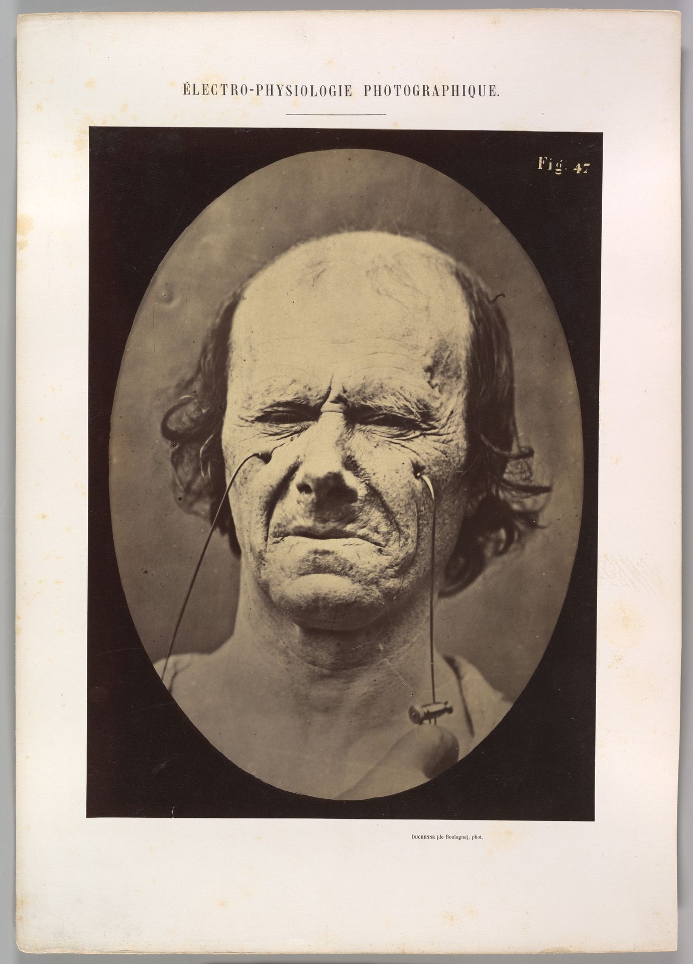 Figure 47: A suggestion of this same weeping by Guillaume Benjamin Amand Duchenne