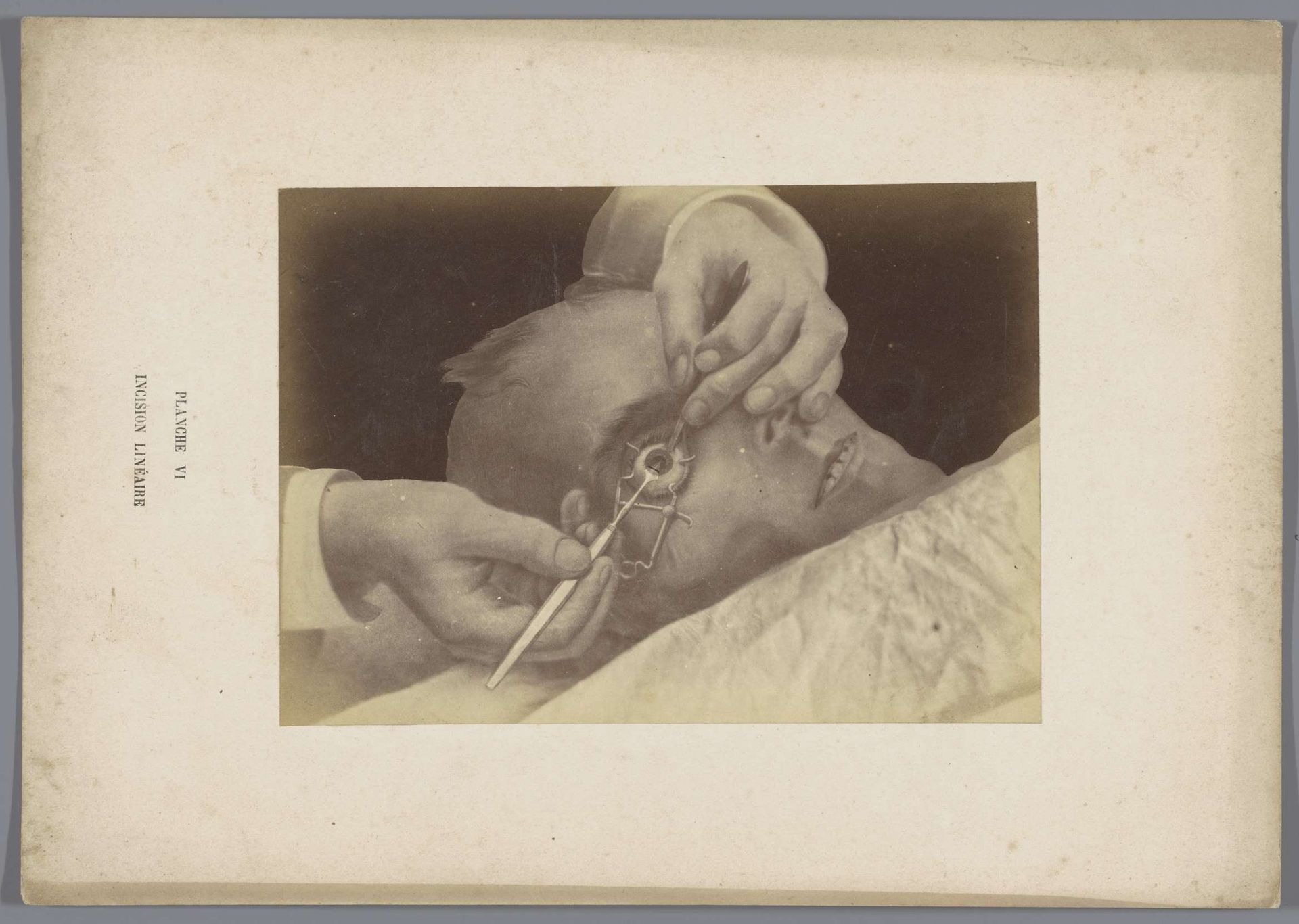 Fotoreproductie van een tekening, voorstellende het maken van een rechtlijnige incisie in een oog tijdens een operatie by A. de Montméja