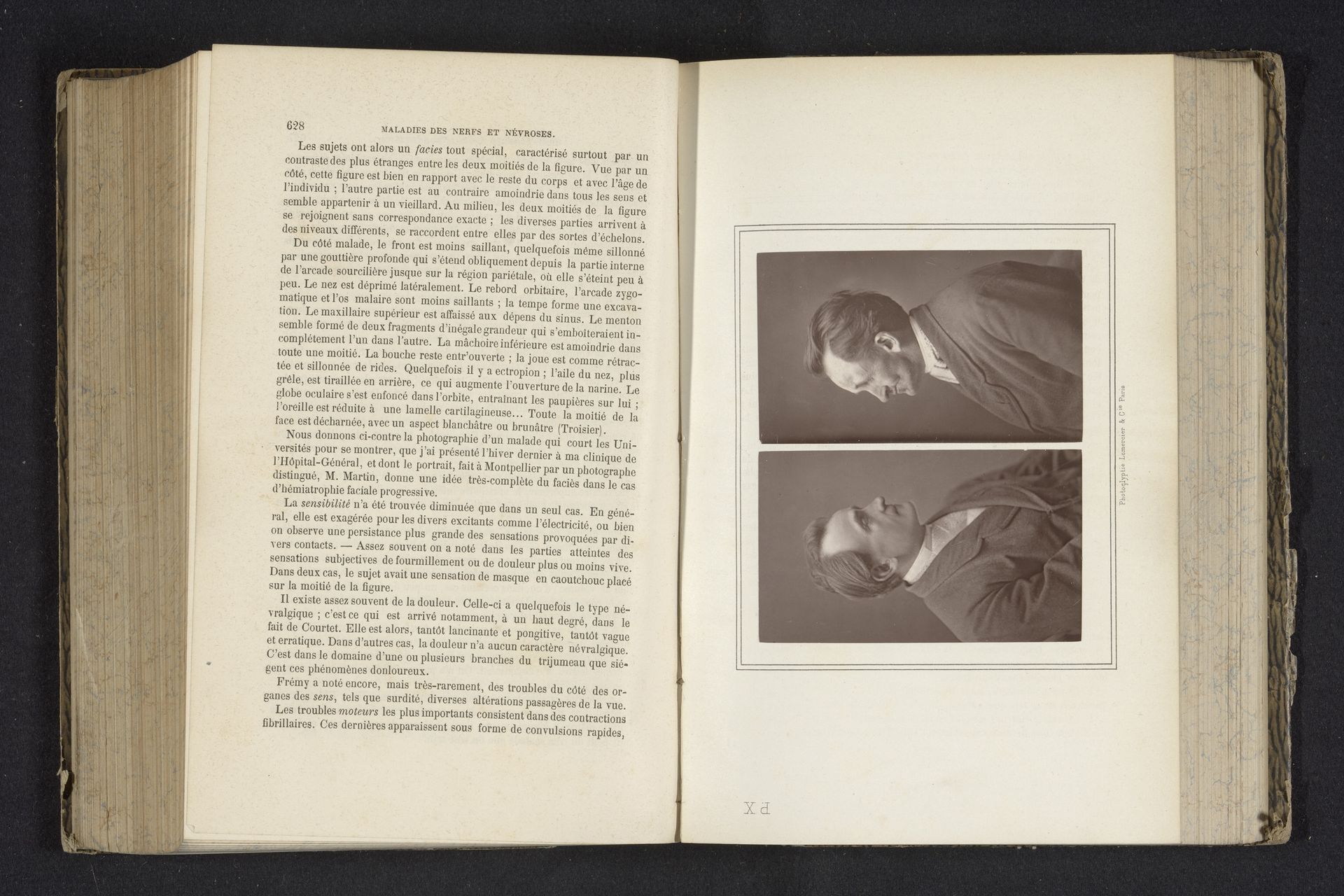 Twee portretten van een patiënt met het Parry–Rombergsyndroom by Ch. Martin