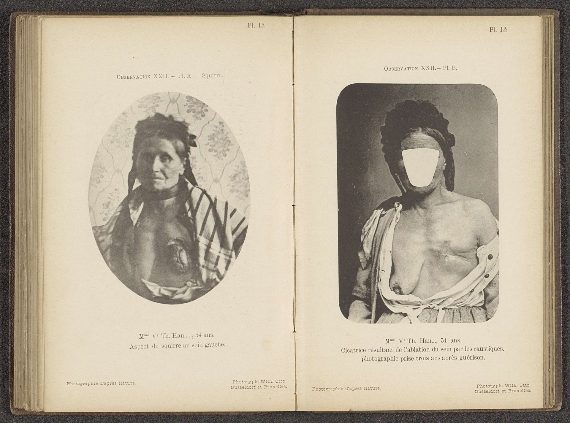 Vrouw met een borsttumor by Anonymous