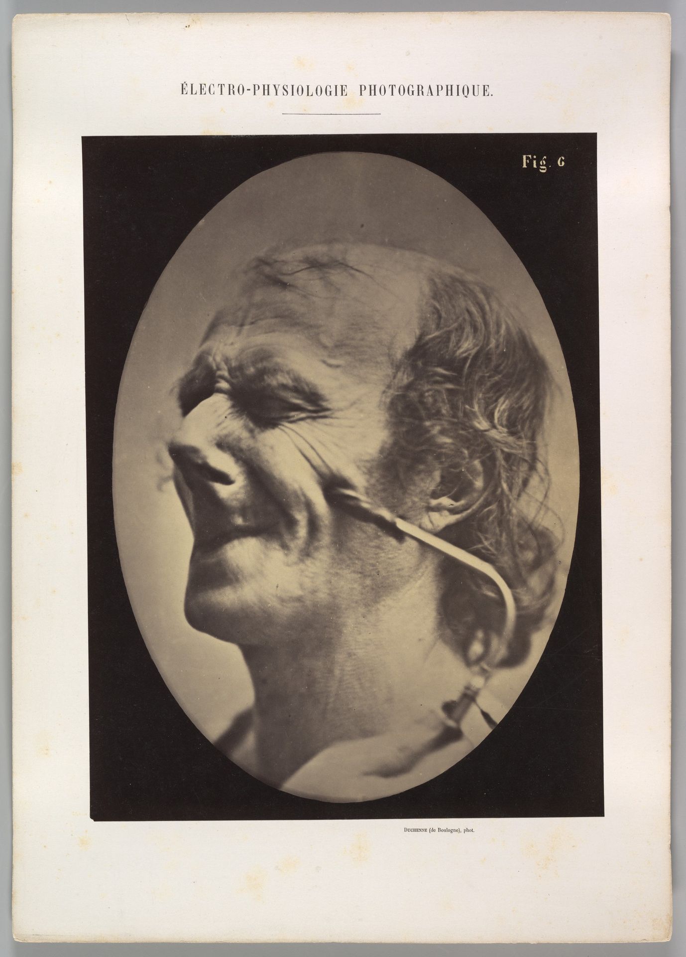 Figure 6: The grimice produced is similar to a tic of the face by Guillaume Benjamin Amand Duchenne