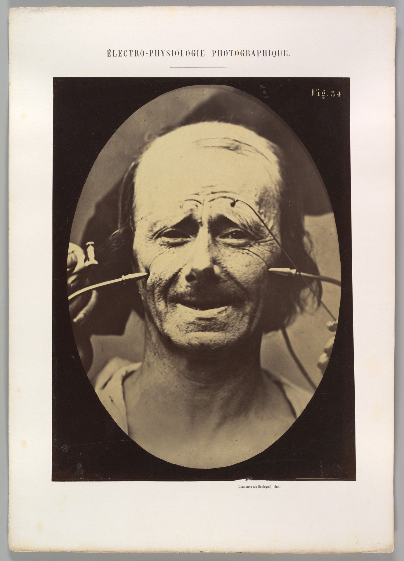 Figure 34: Grimace by Guillaume Benjamin Amand Duchenne