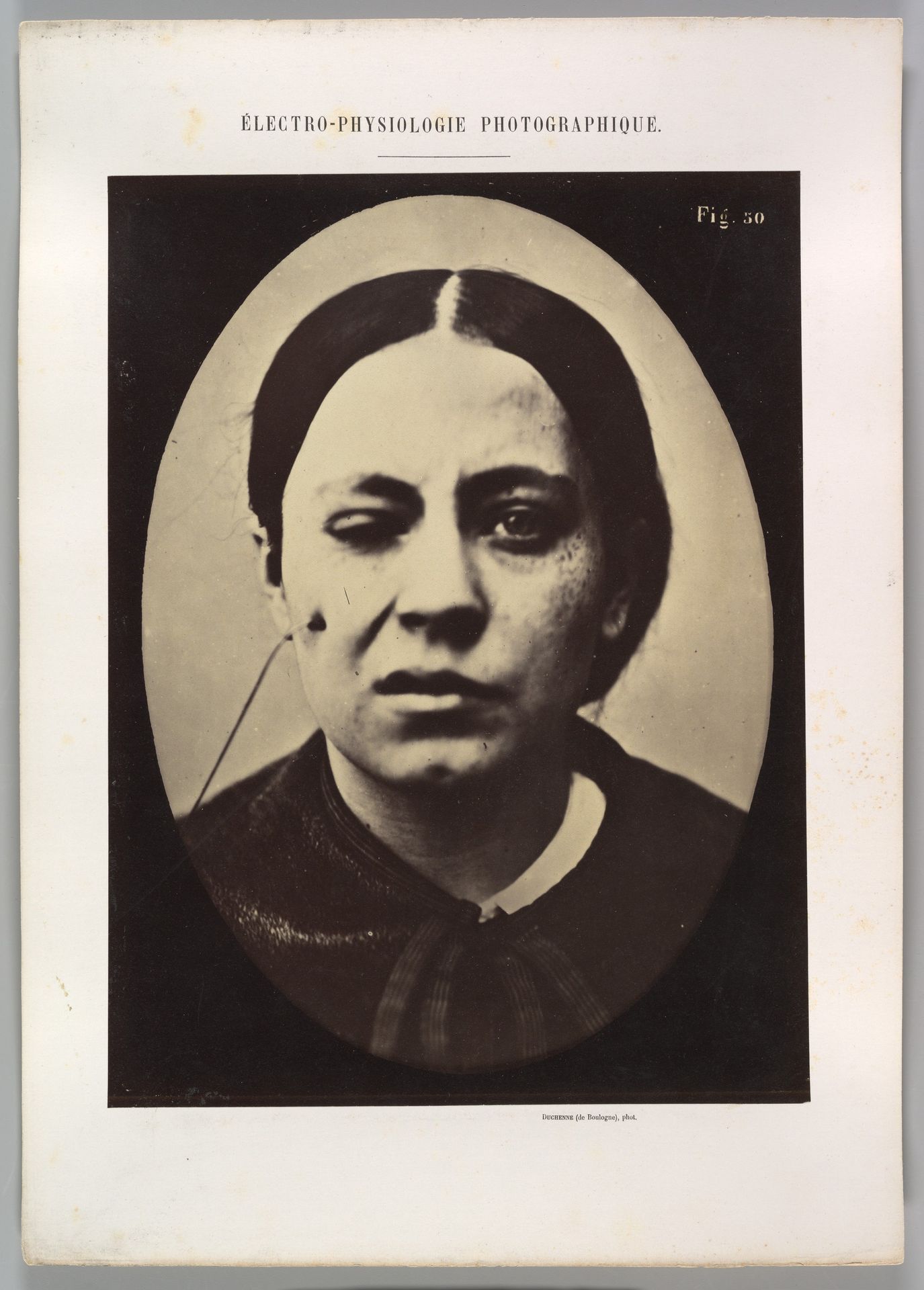 Figure 50: Affected weeping and face in repose by Guillaume Benjamin Amand Duchenne