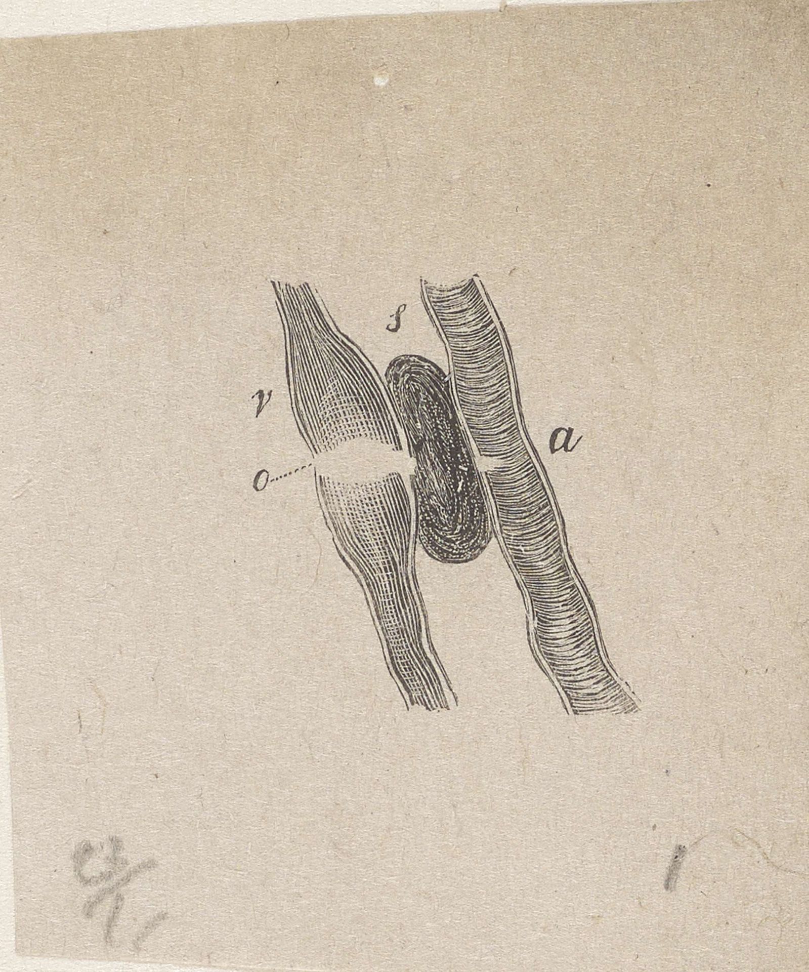 Onderdeel van het menselijk lichaam met een afwijking by Isaac Weissenbruch