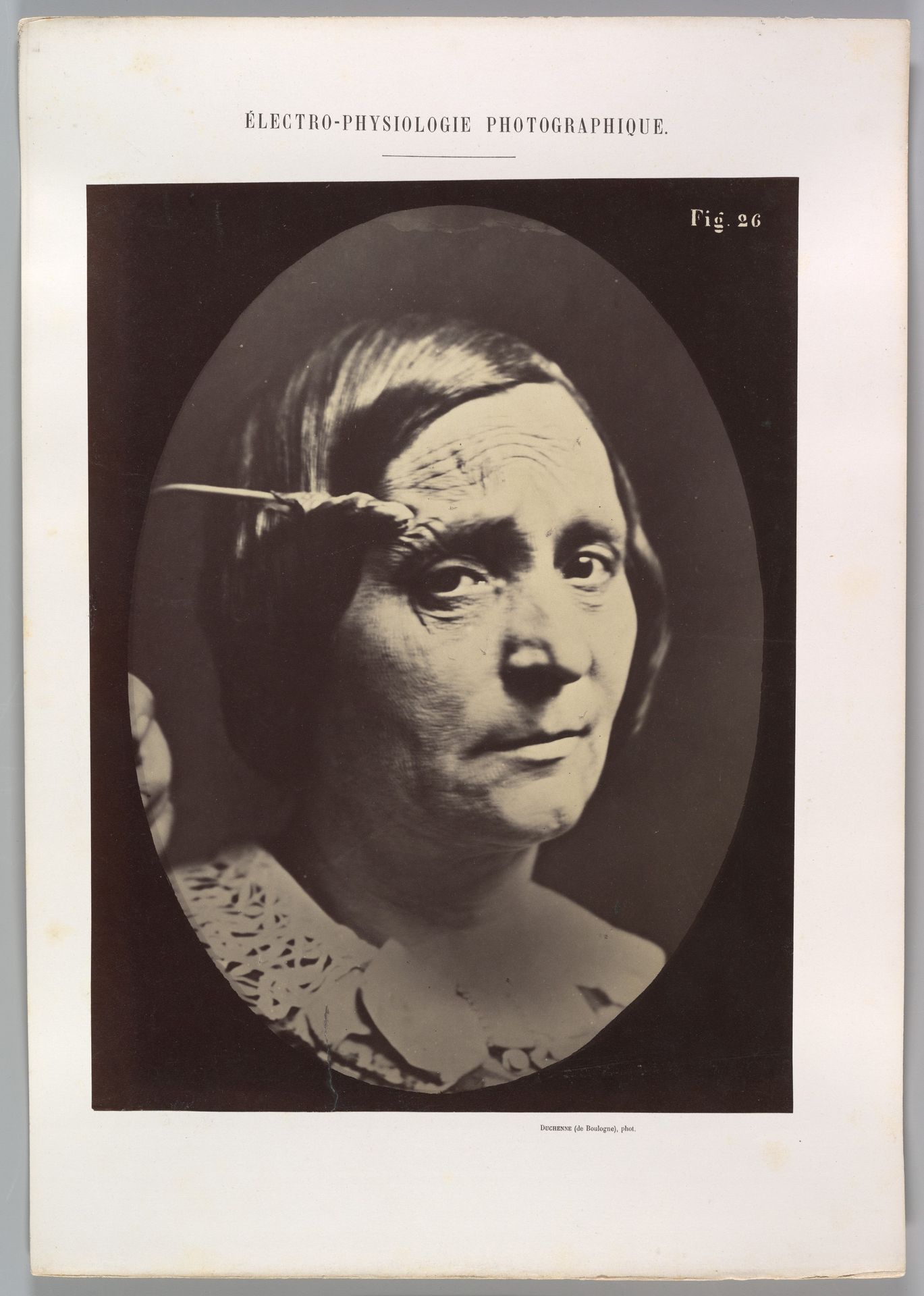 Figure 26: Expression of painful attention and attention, attentive gaze. by Guillaume Benjamin Amand Duchenne