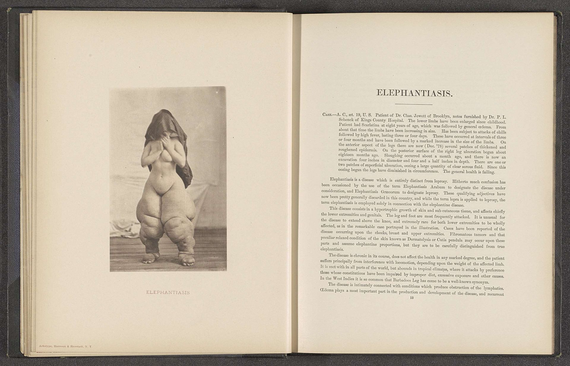 Patiënt lijdend aan de huidziekte 'elephantiasis' by Anonymous