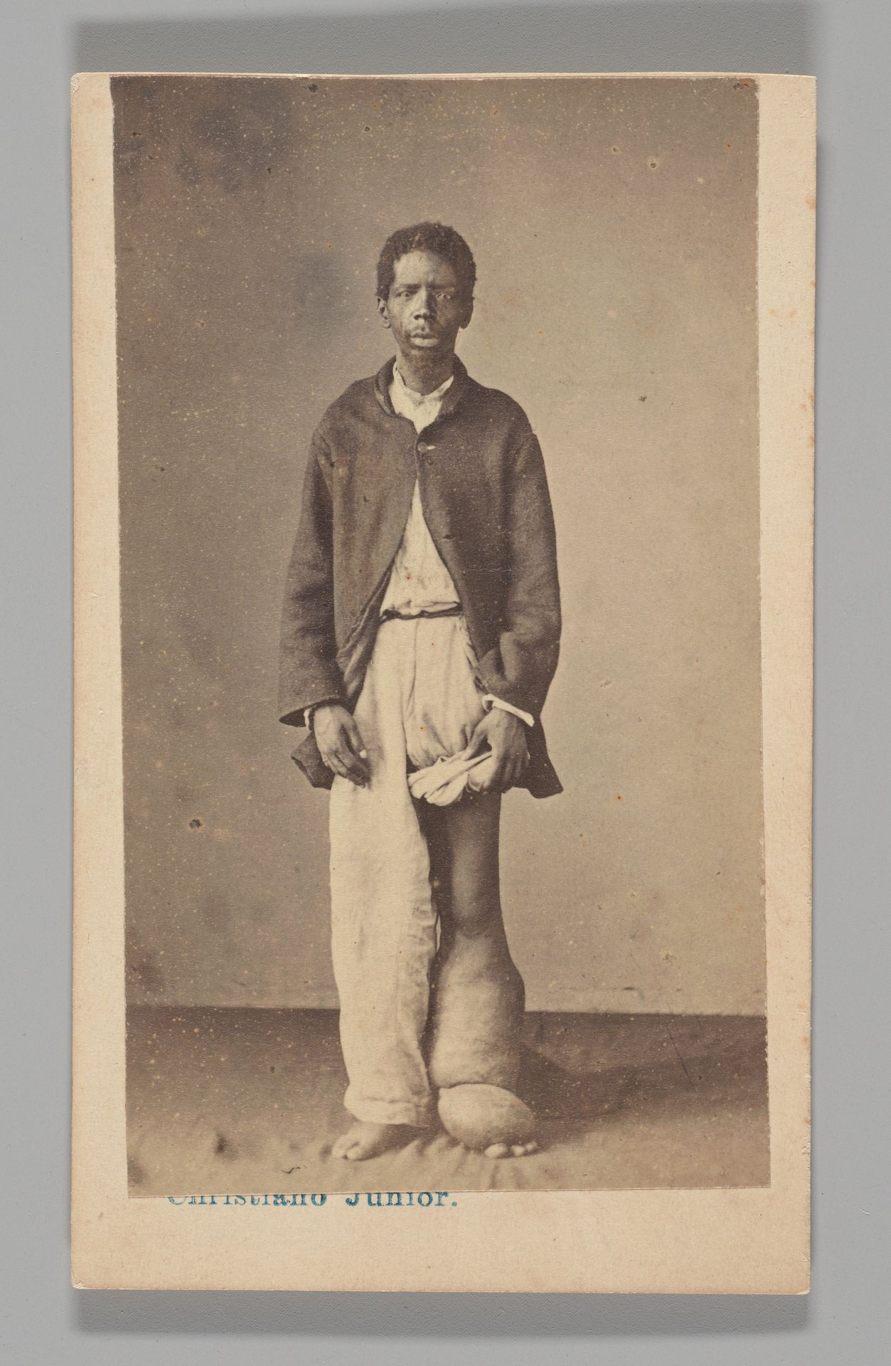 [Studio Portrait: Man Standing with Swollen Leg and Foot Caused by Elephantiasis, Brazil] by Christiano Junior