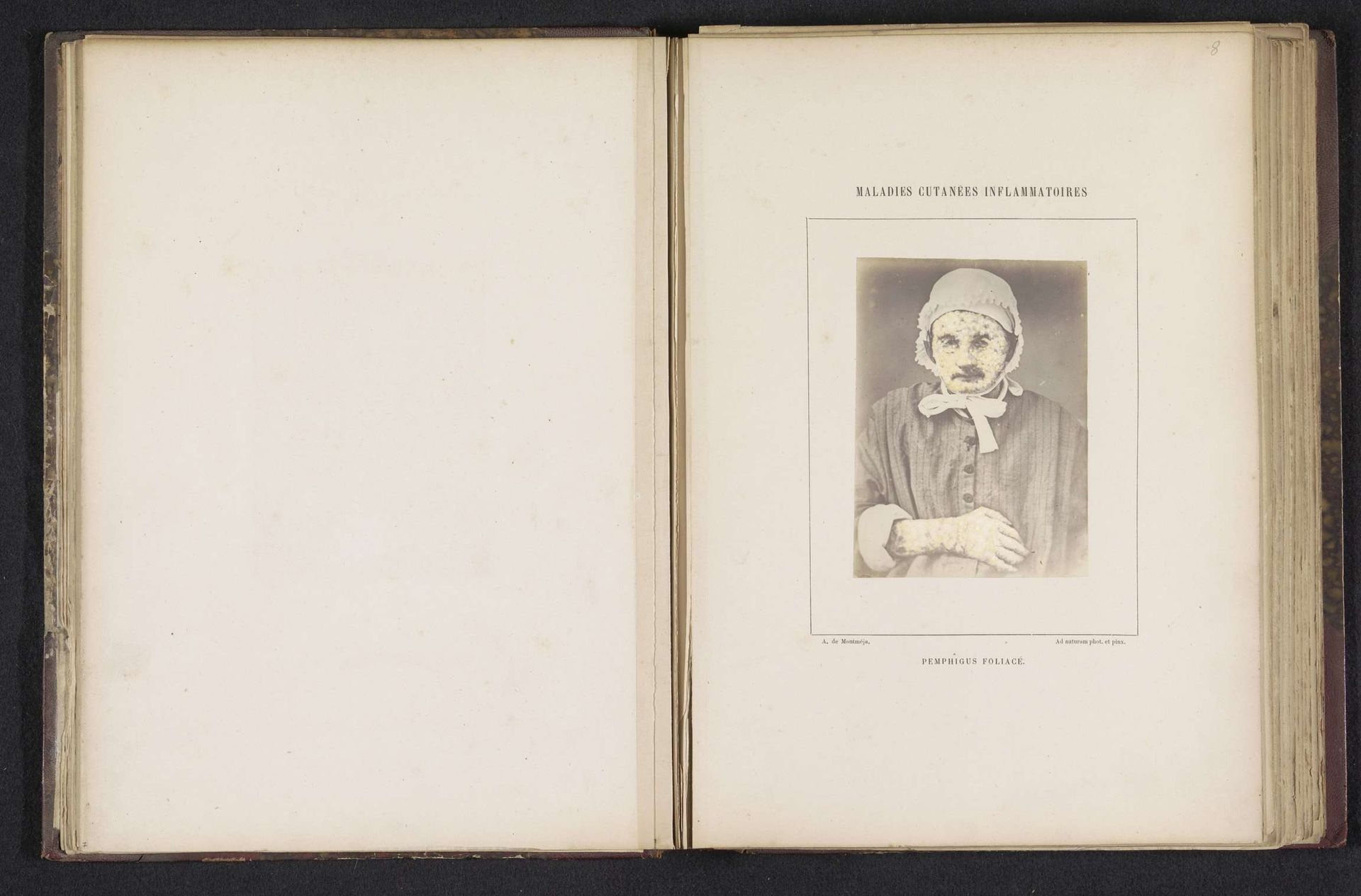 Portret van een onbekende man die lijdt aan pemphigus foliaceus by A. de Montméja
