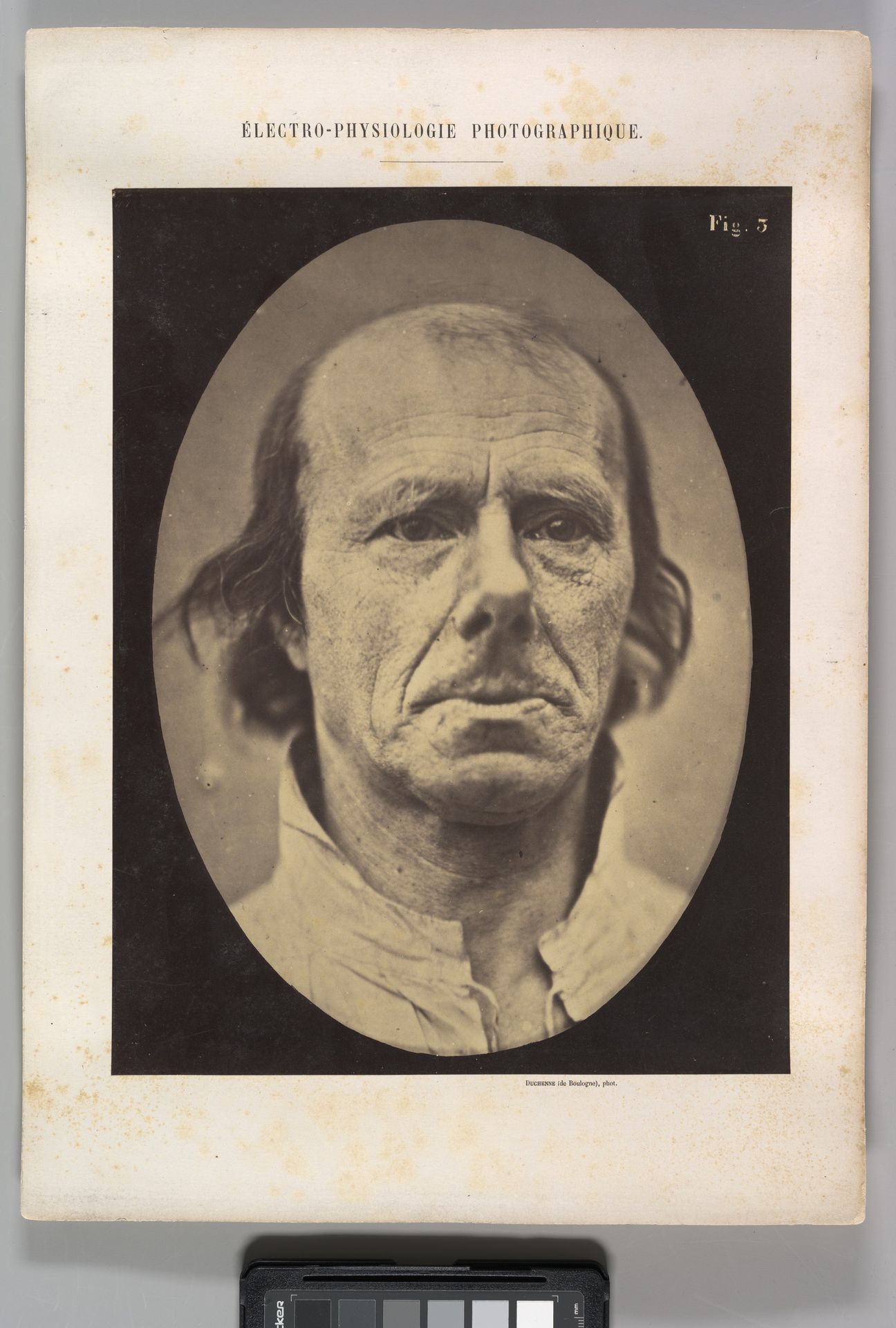 Figure 3: The face of an old man... photographed in repose. by Guillaume Benjamin Amand Duchenne