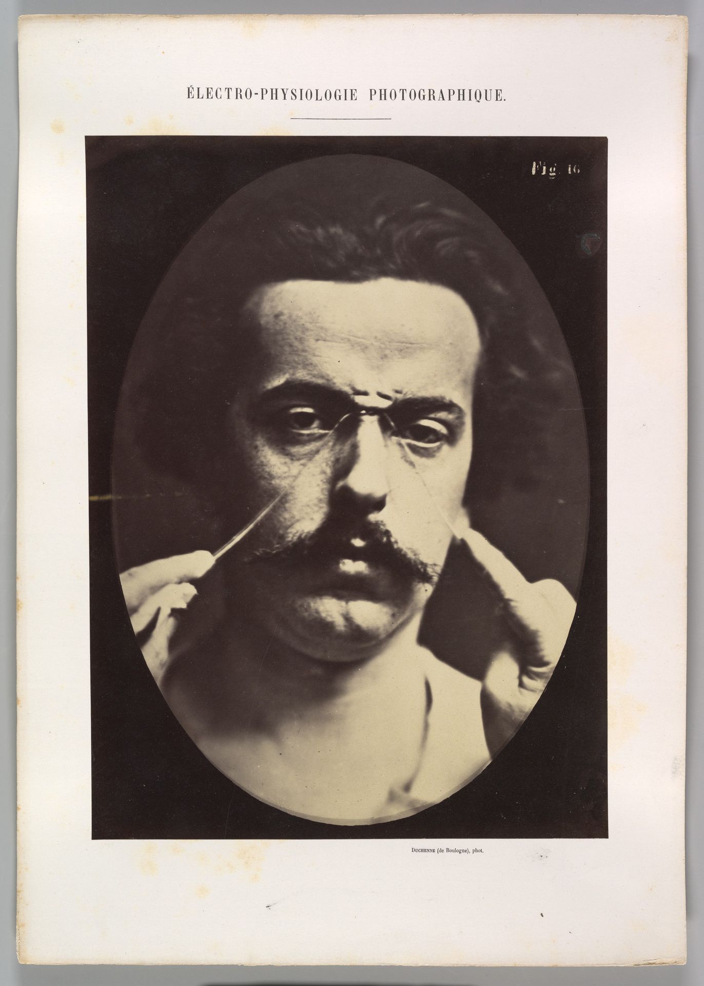 Figure 16: Expression of severity by Guillaume Benjamin Amand Duchenne