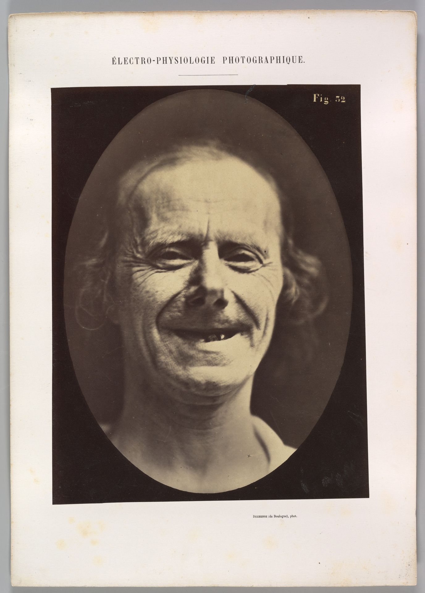 Figure 52: Voluntary retraction of the lower lip by Guillaume Benjamin Amand Duchenne