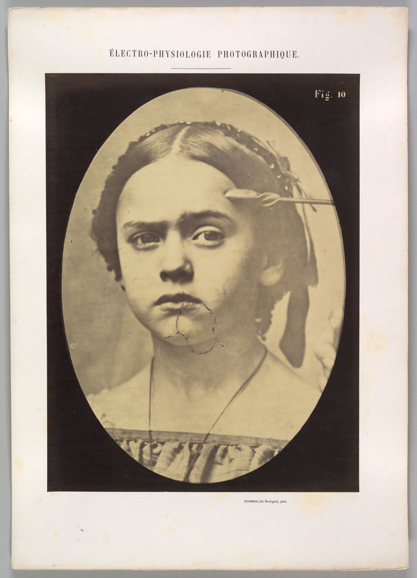 Figure 10: Showing the expressive lines of m. frontalis in a young girl by Guillaume Benjamin Amand Duchenne