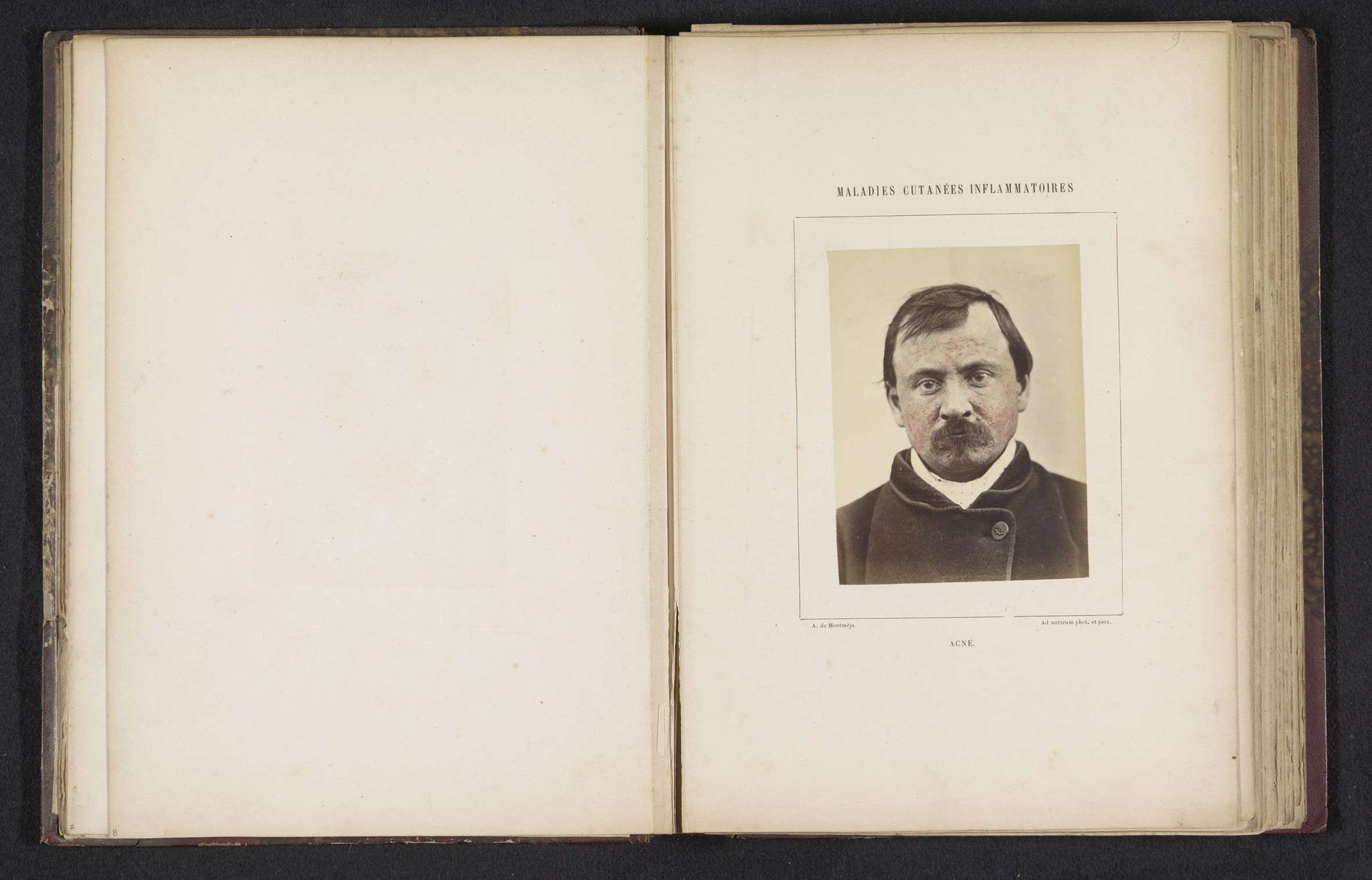 Portret van een onbekende man die lijdt aan acne by A. de Montméja